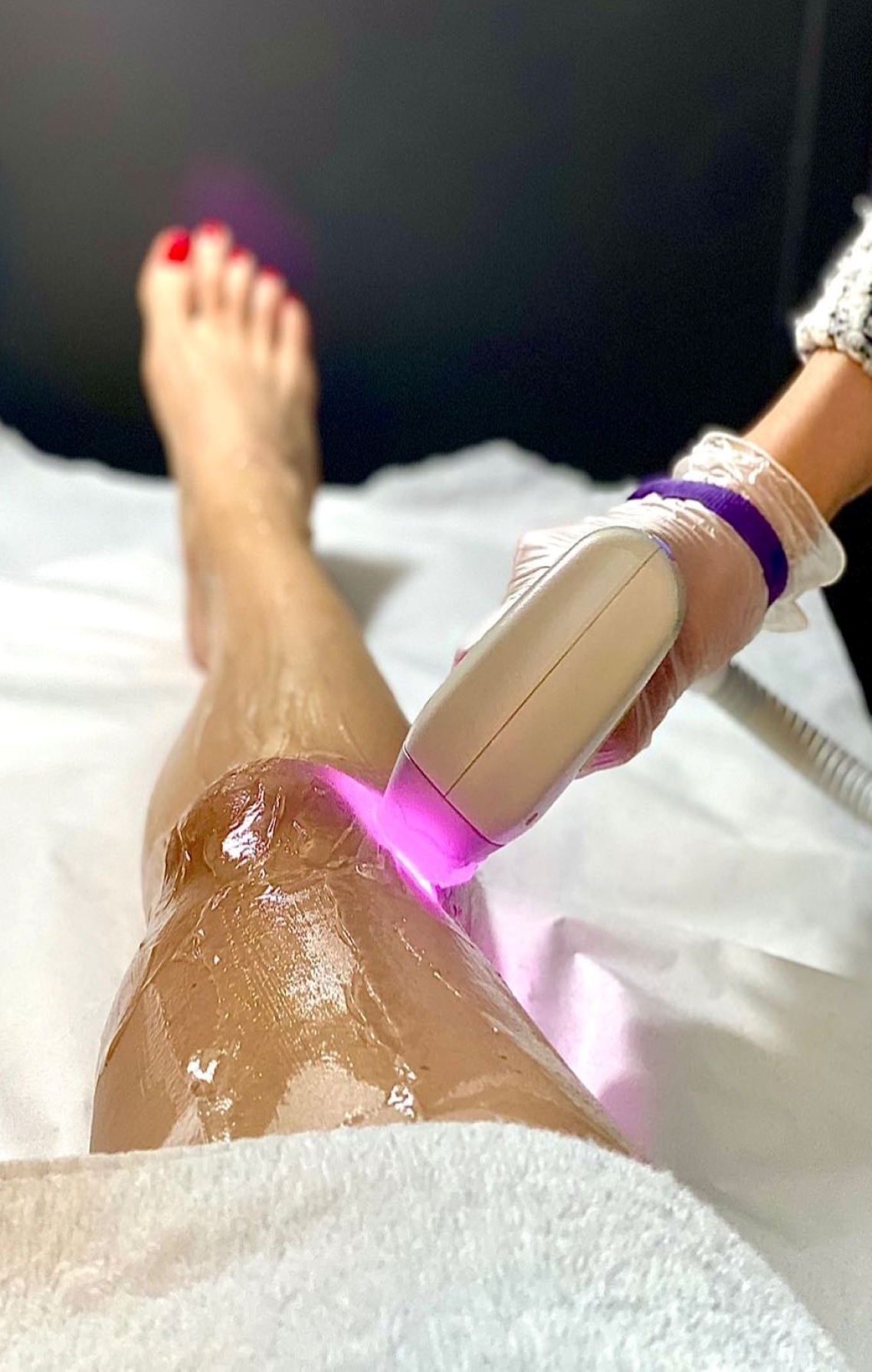 Laser Hair Removal