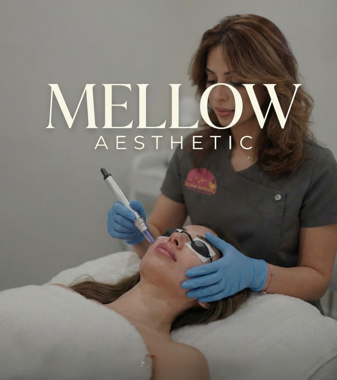 Microneedling treatment in progress