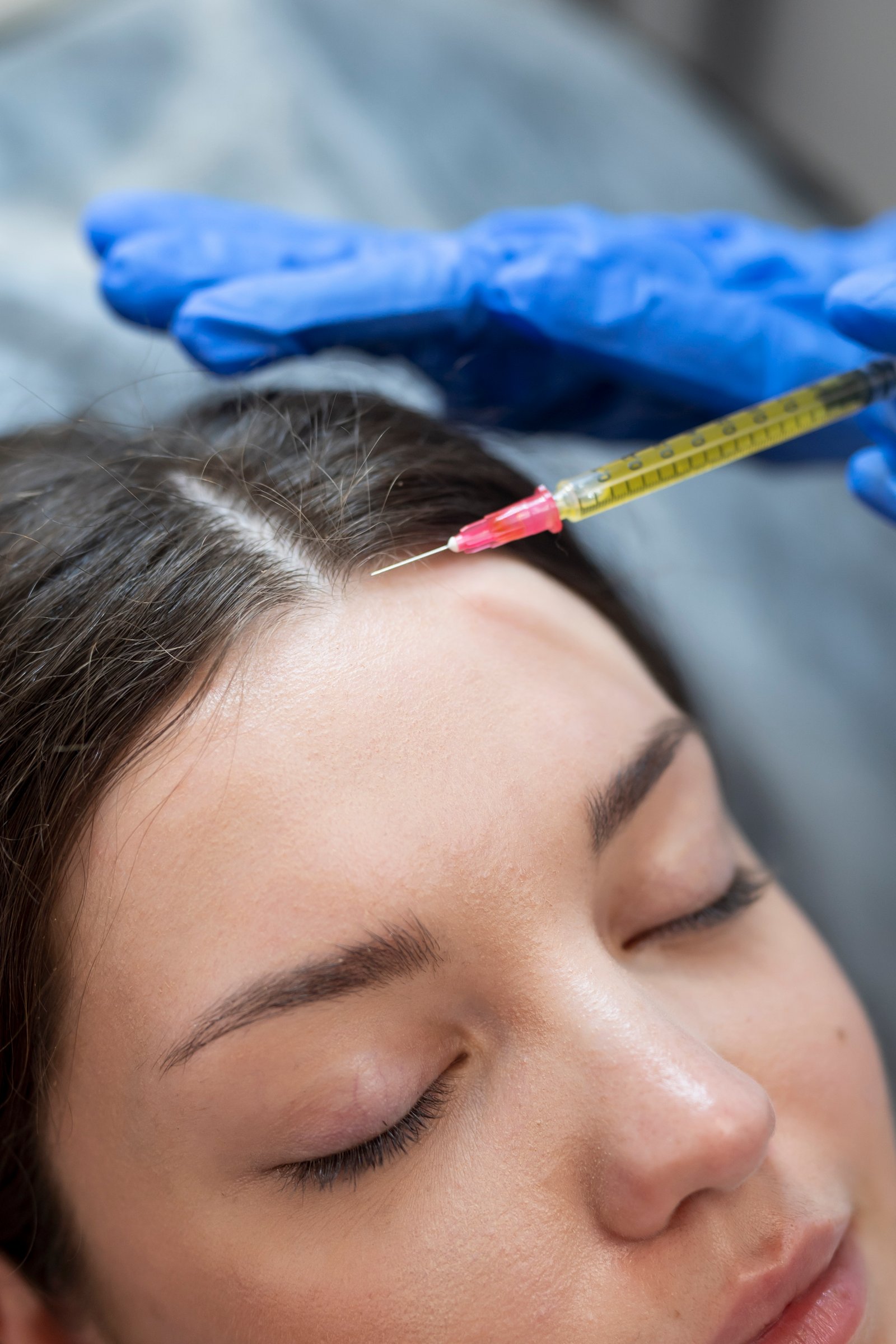 Scalp Microneedling